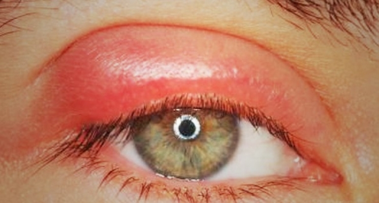 Terkena Alergi Yang Membuat Mata Bengkak? Jangan Panik Dan Coba Cara Ini Guys!