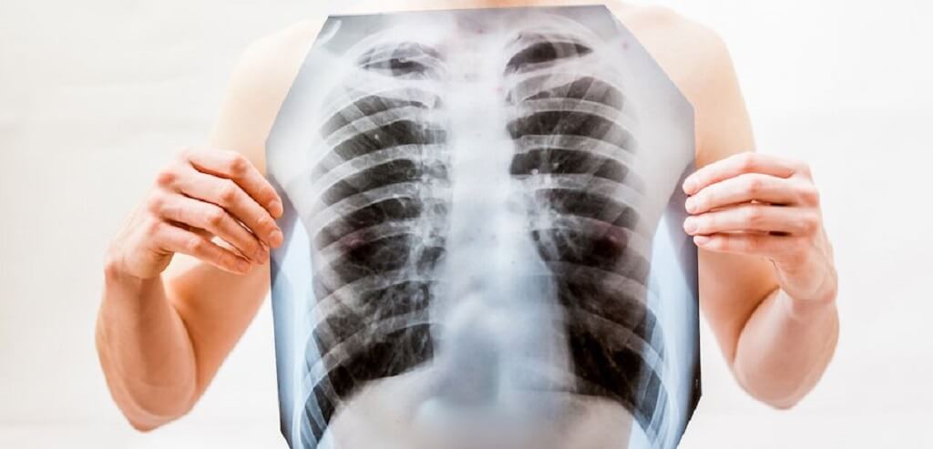 Penyebab dari Paru-paru Basah